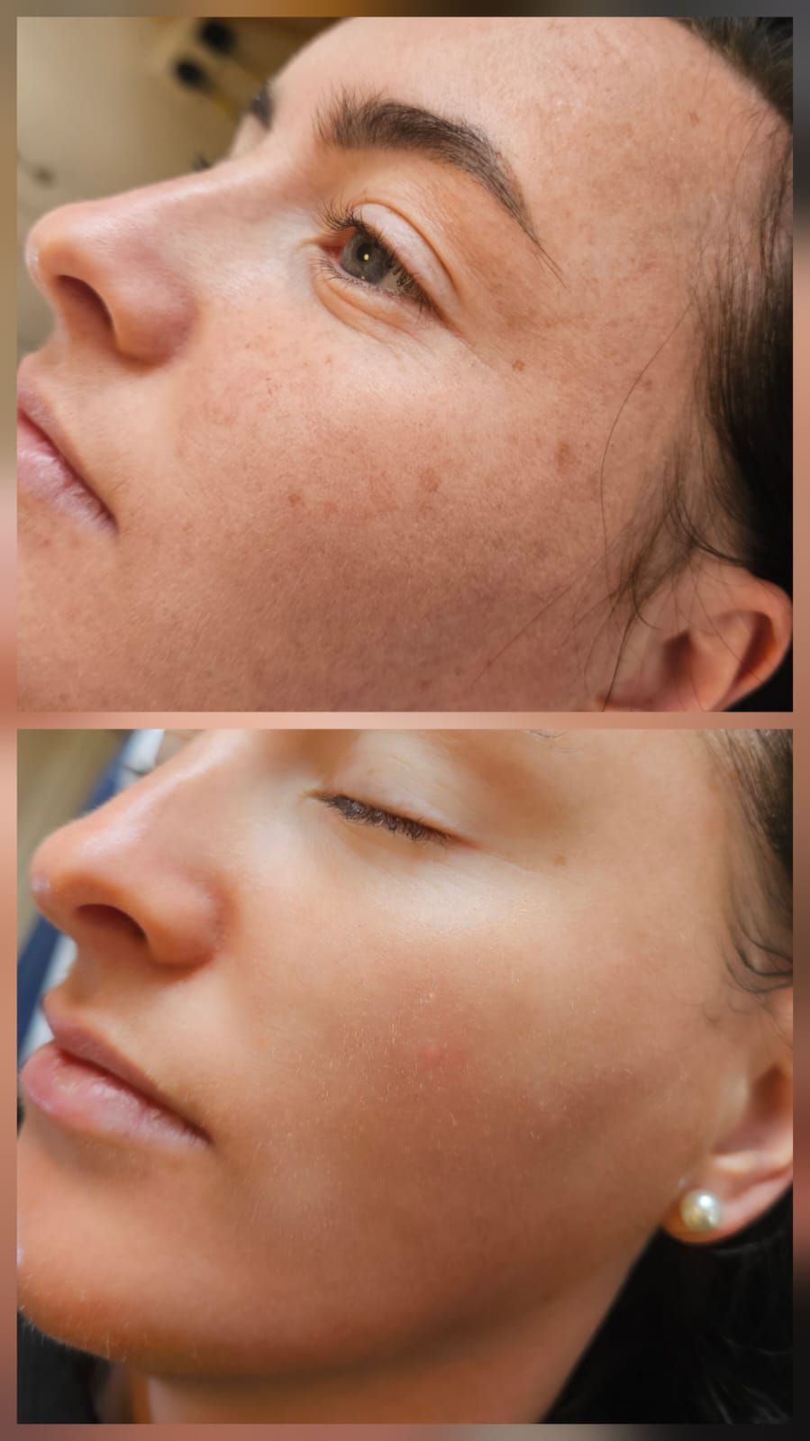 chemical peel